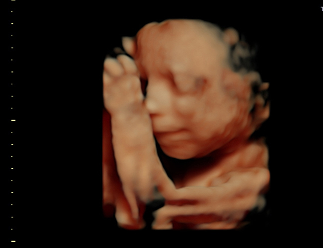 3D ultrasound image at 25 weeks